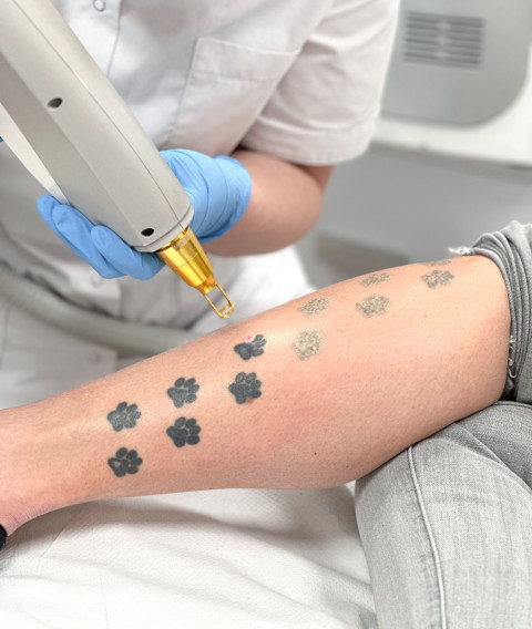 Tattoeage verwijdering